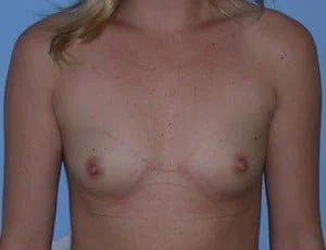 Breast Augmentation before