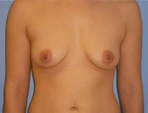 Breast Augmentation before