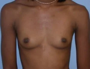 Breast Augmentation before