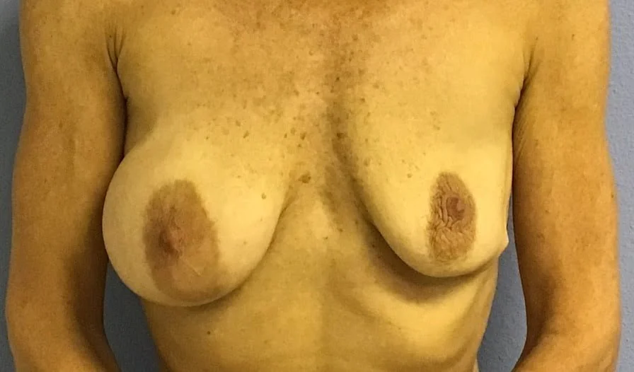 Breast Implant Revision before