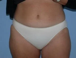 case110-before207-Liposuction-TampaPalmPlasticSurgery