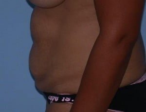 before264 Tummy Tuck Tampa Palm Plastic Surgery Group