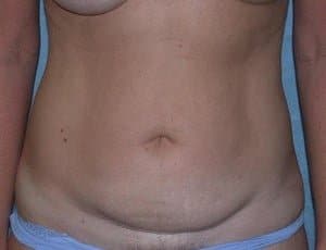 before266 Tummy Tuck Tampa Palm Plastic Surgery Group