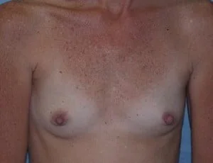 before319-Breast Augmentation at Tampa Palm Plastic Surgery Group
