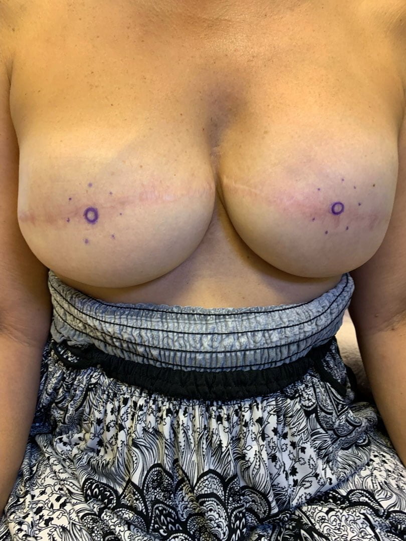 before423-Breast Reconstruction at Tampa Palm Plastic Surgery Group