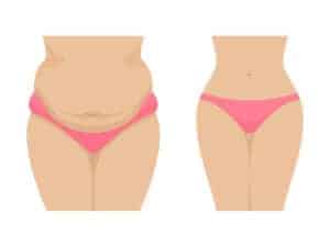 Three Common Procedures After Extreme Weight Loss