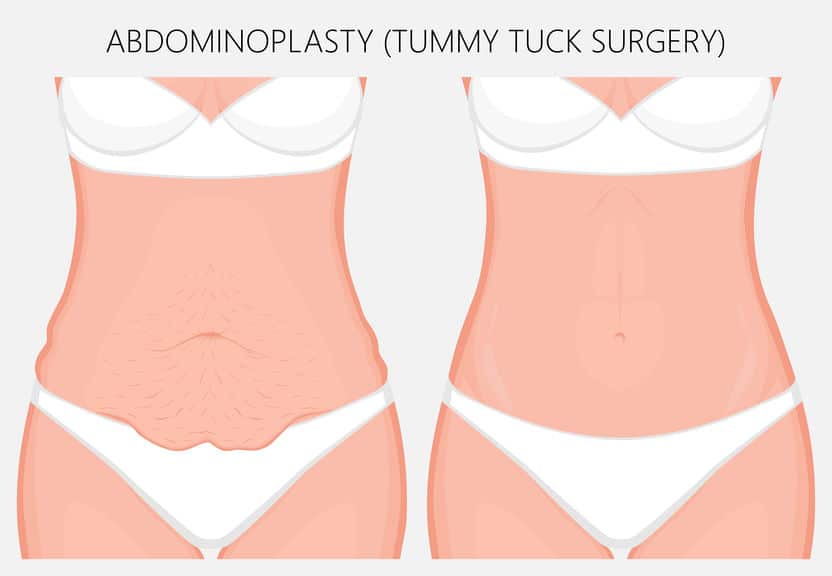 tummy-tuck