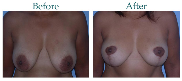 Breast Life Before and After Case 117