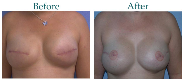 breast-reconstruction-before-after-case-131.jpg