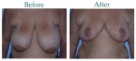 breast-reduction-before-after-case-111.jpg